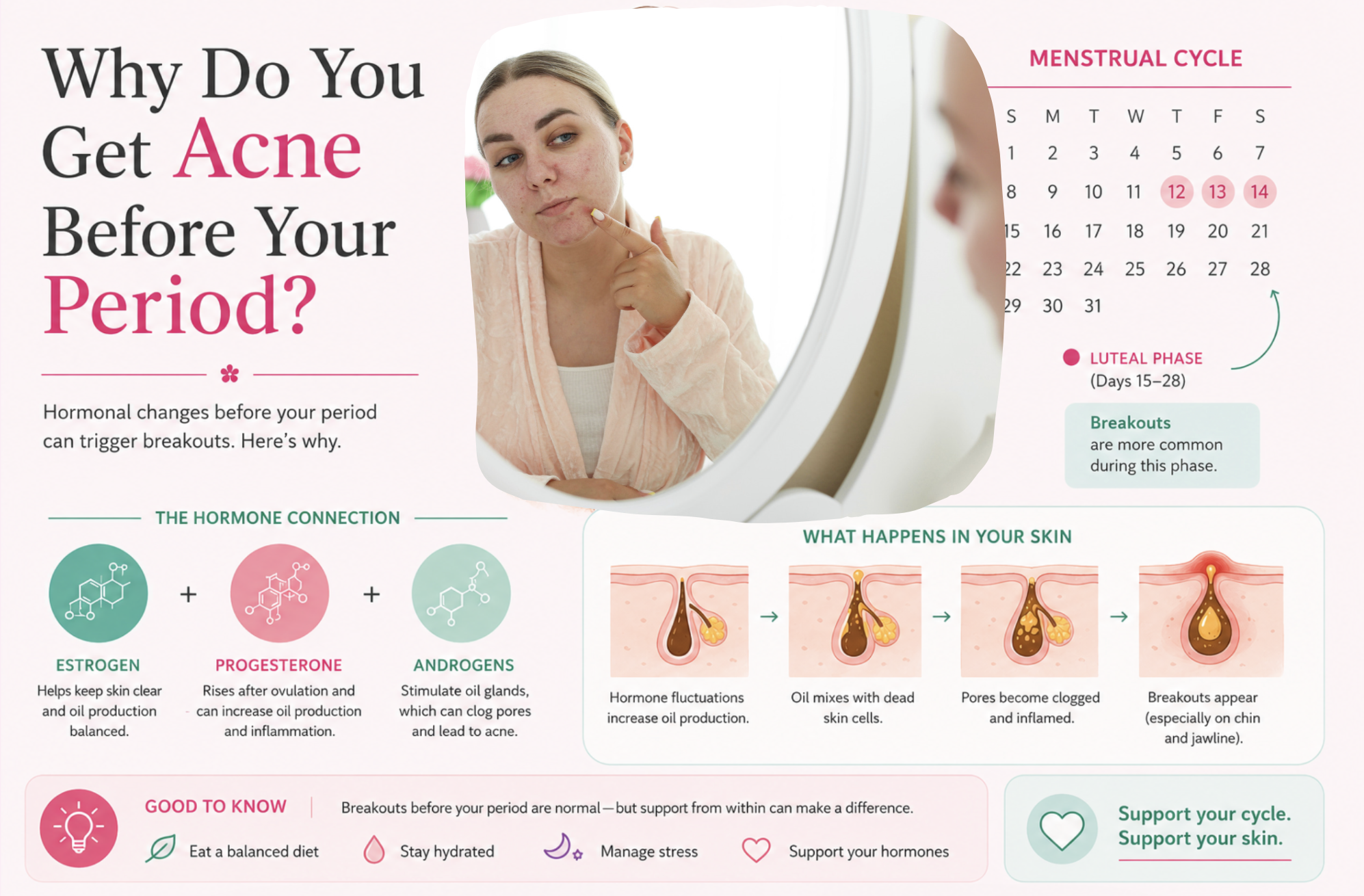 Illustration showing how hormonal changes before menstruation can contribute to acne breakouts on the chin, jawline, and face during the days leading up to a period.